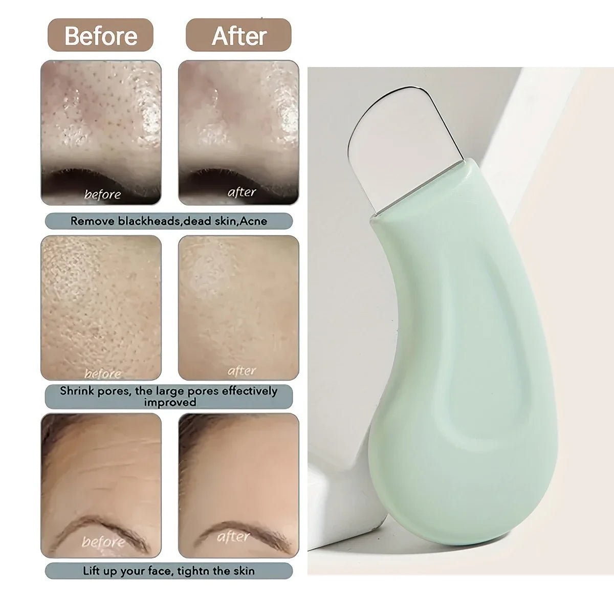 Blackhead and Whitehead Removal Tool for Nose and Face - Skin Pore Cleaner Skin Care Tools for Women - memorylane shop