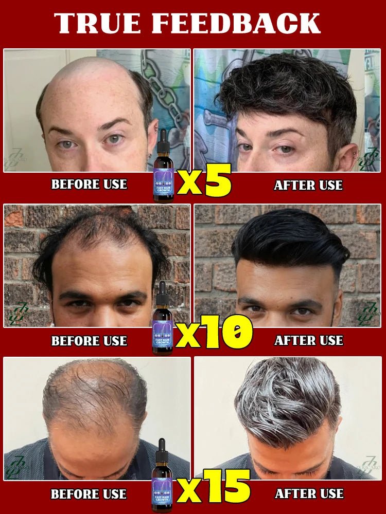 ZKRICARO 0fficial genuine, high quality hair growth essence 0il, scalp care, make hair grow thicker, no more baIIdness - memorylane shop