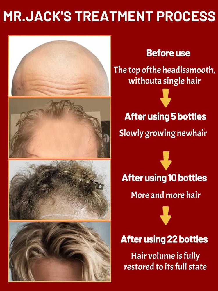 ZKRICARO 0fficial genuine, high quality hair growth essence 0il, scalp care, make hair grow thicker, no more baIIdness - memorylane shop