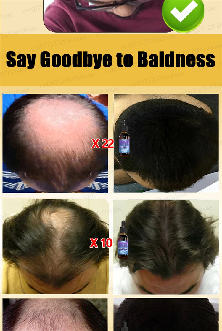 ZKRICARO 0fficial genuine, high quality hair growth essence 0il, scalp care, make hair grow thicker, no more baIIdness