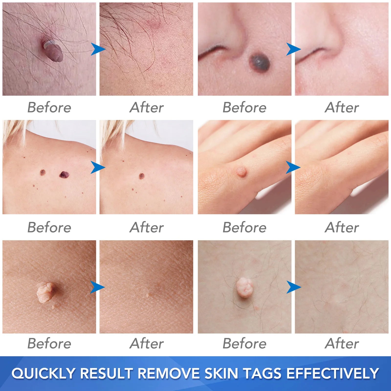 Simple Wart Removal Tool Set Skin Tag Removeal Tool Easy To Clean Skin Care Tool Skin Tag Removal Care Products