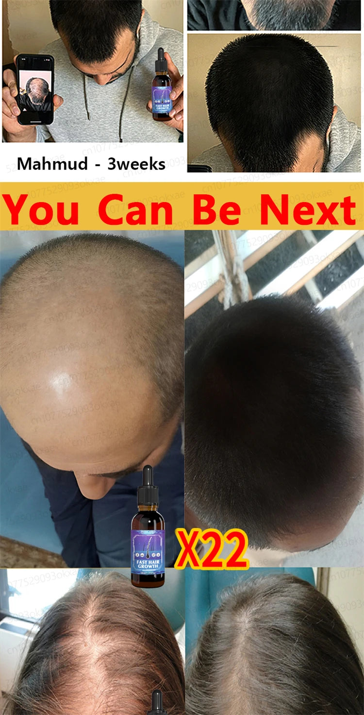 ZKRICARO 0fficial genuine, high quality hair growth essence 0il, scalp care, make hair grow thicker, no more baIIdness