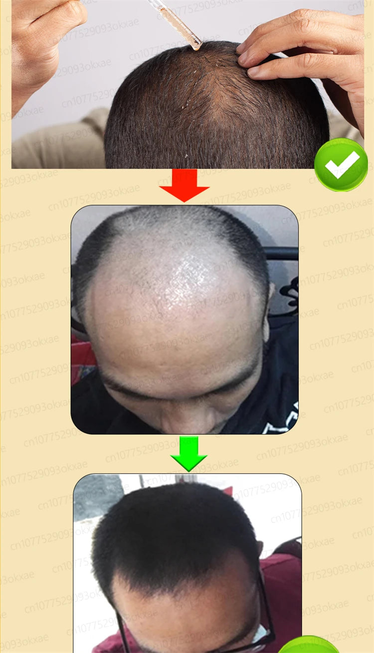 ZKRICARO 0fficial genuine, high quality hair growth essence 0il, scalp care, make hair grow thicker, no more baIIdness