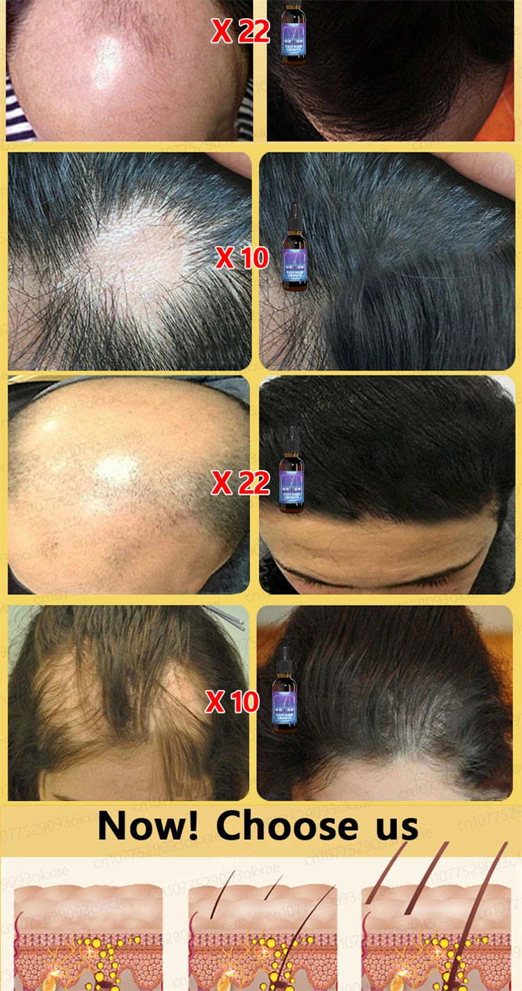 ZKRICARO 0fficial genuine, high quality hair growth essence 0il, scalp care, make hair grow thicker, no more baIIdness