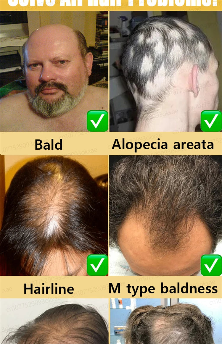 ZKRICARO 0fficial genuine, high quality hair growth essence 0il, scalp care, make hair grow thicker, no more baIIdness