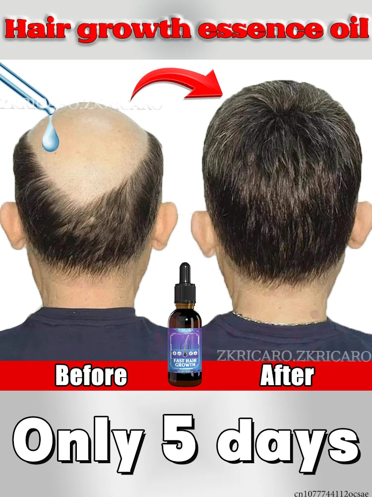 ZKRICARO 0fficial genuine, high quality hair growth essence 0il, scalp care, make hair grow thicker, no more baIIdness