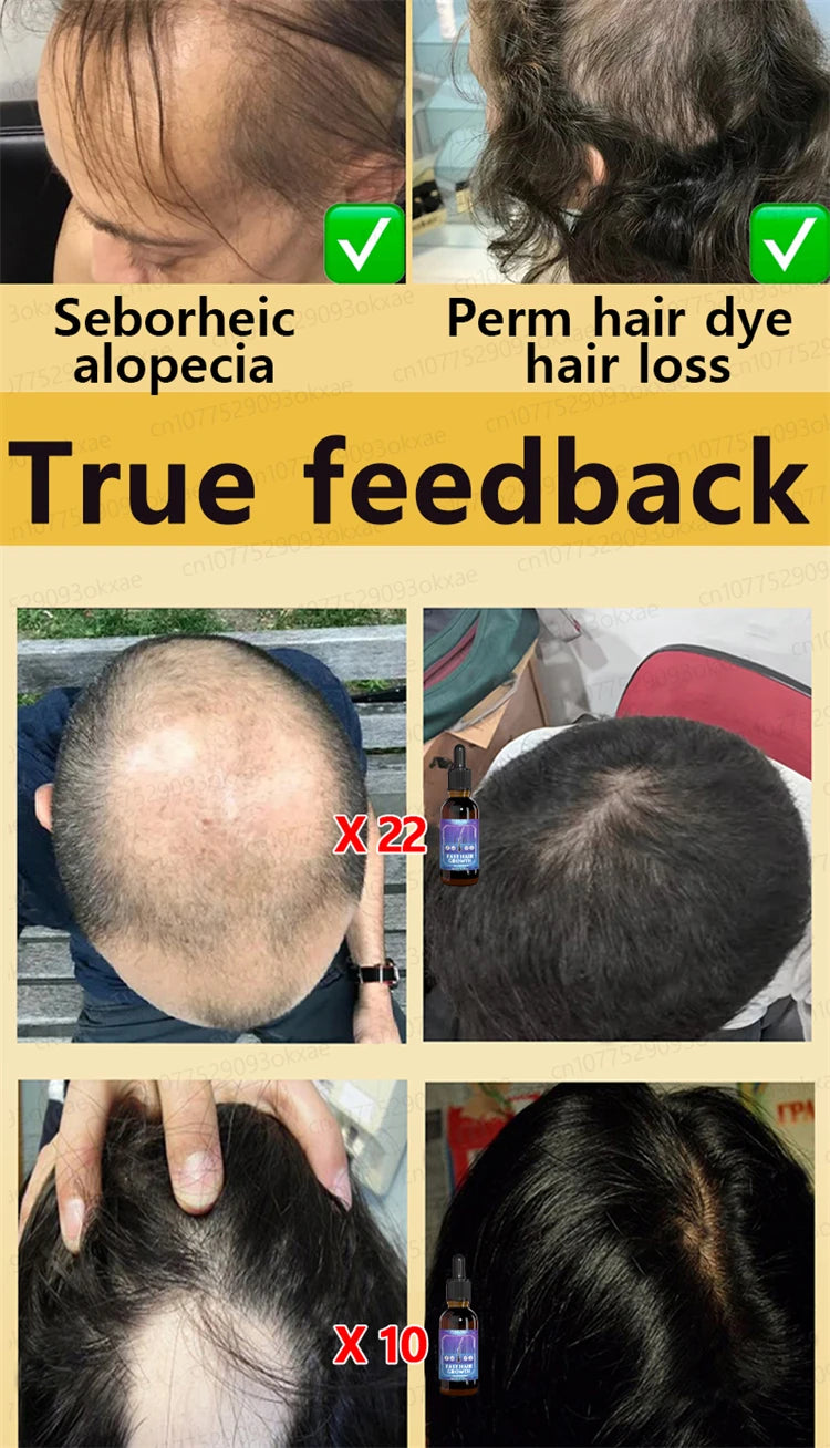 ZKRICARO 0fficial genuine, high quality hair growth essence 0il, scalp care, make hair grow thicker, no more baIIdness