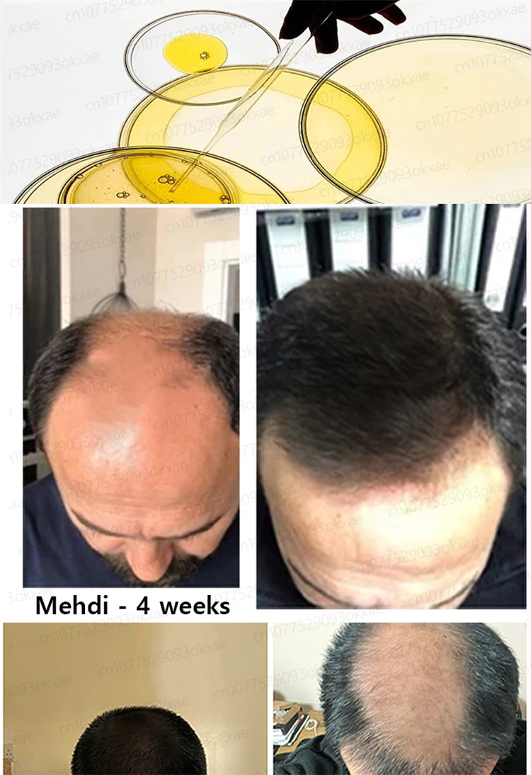 ZKRICARO 0fficial genuine, high quality hair growth essence 0il, scalp care, make hair grow thicker, no more baIIdness