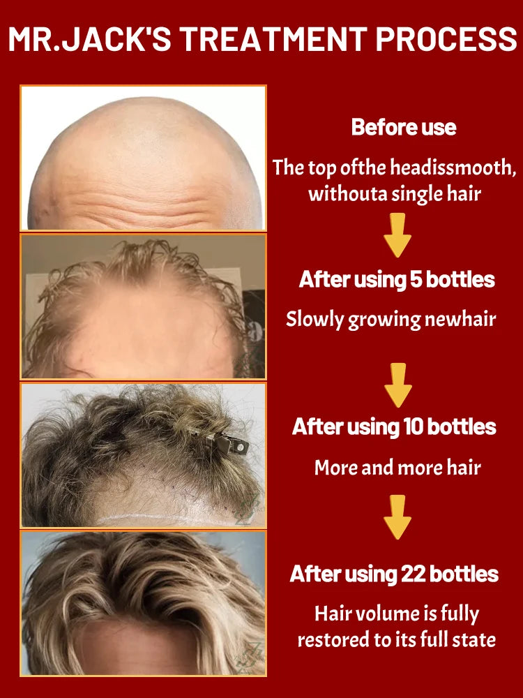 ZKRICARO 0fficial genuine, high quality hair growth essence 0il, scalp care, make hair grow thicker, no more baIIdness