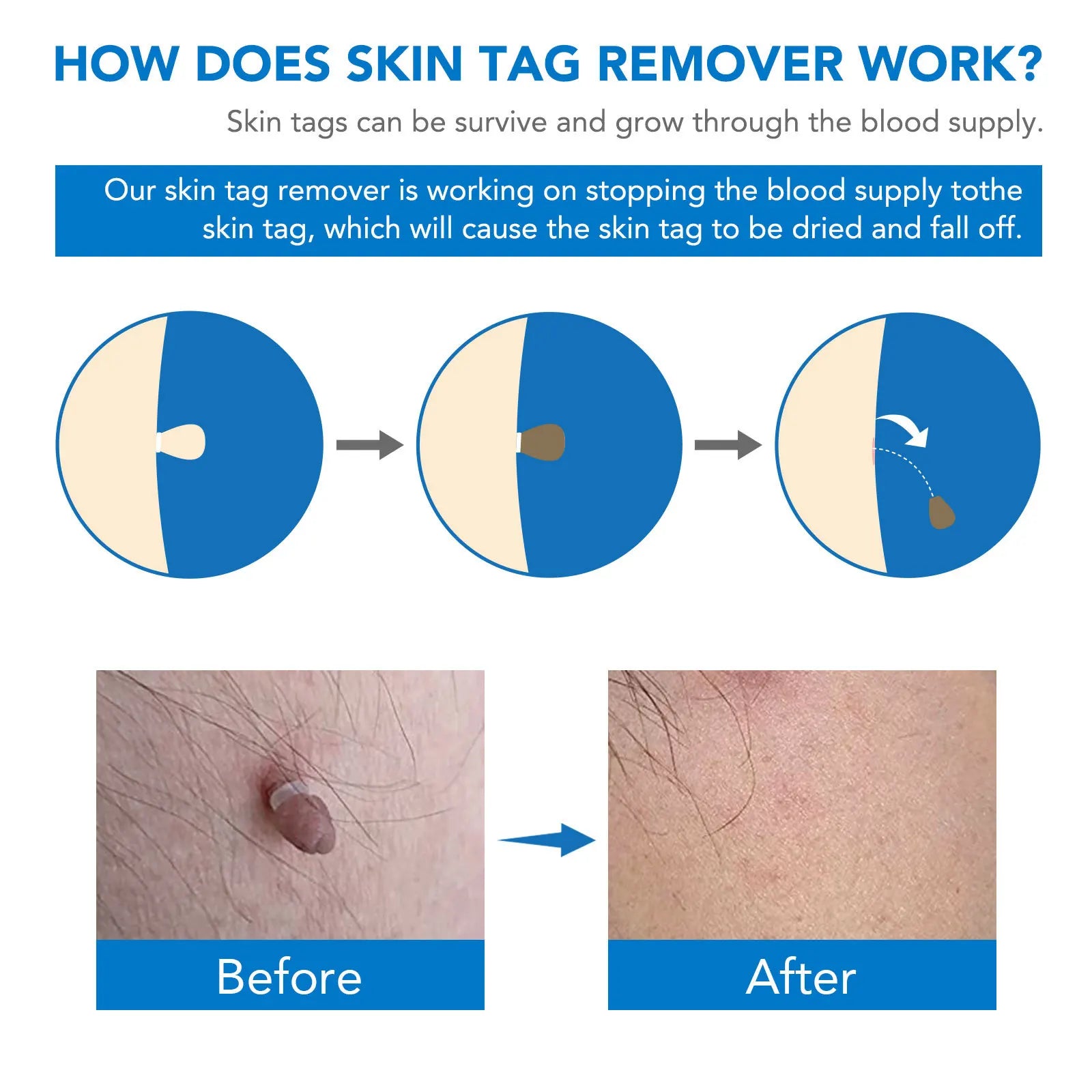 Simple Wart Removal Tool Set Skin Tag Removeal Tool Easy To Clean Skin Care Tool Skin Tag Removal Care Products - memorylane shop