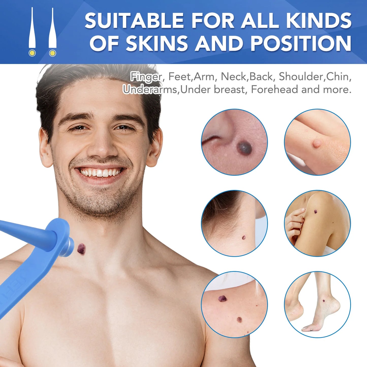 Simple Wart Removal Tool Set Skin Tag Removeal Tool Easy To Clean Skin Care Tool Skin Tag Removal Care Products - memorylane shop