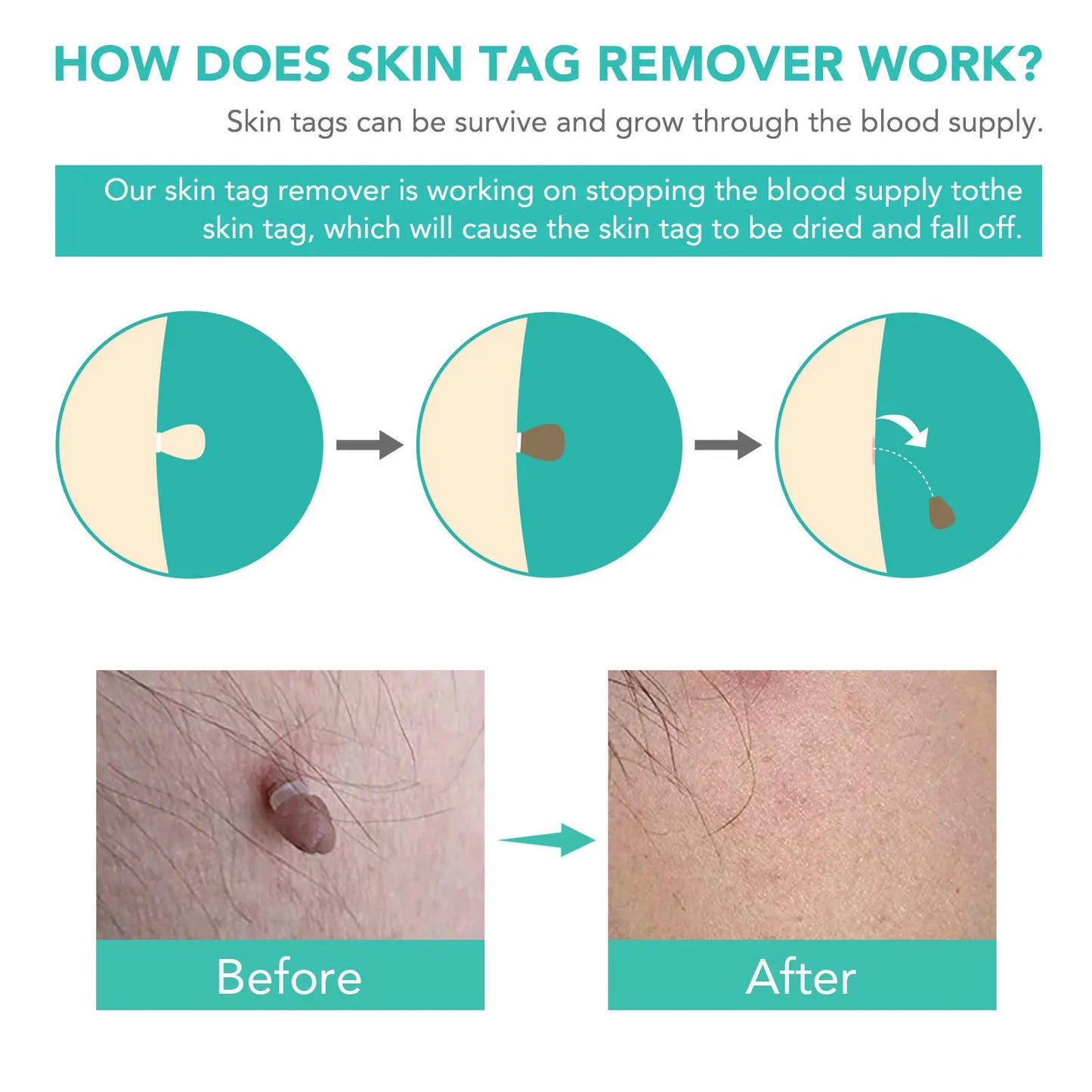Simple Wart Removal Tool Set Skin Tag Removeal Tool Easy To Clean Skin Care Tool Skin Tag Removal Care Products - memorylane shop